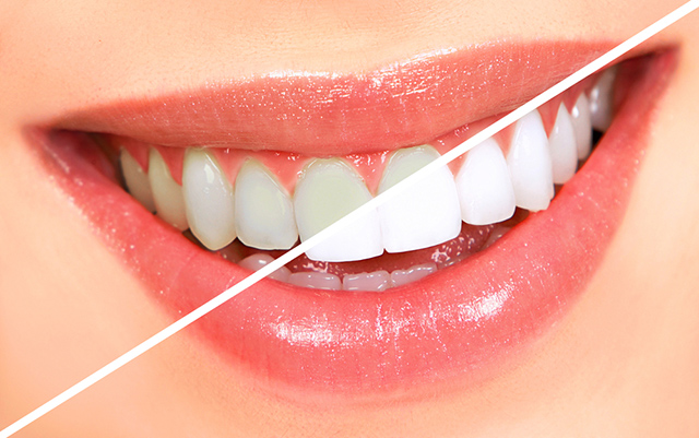 Zahn wird grau wurzelbehandelter Wurzelbehandlung Wie